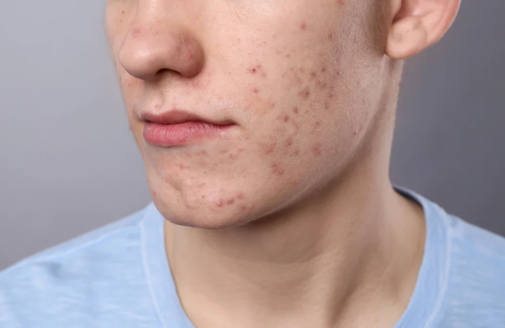 แนะนำวิธีดูแลรอยแผลเป็นจากสิวให้แลดูจางลงที่ BSL Clinic