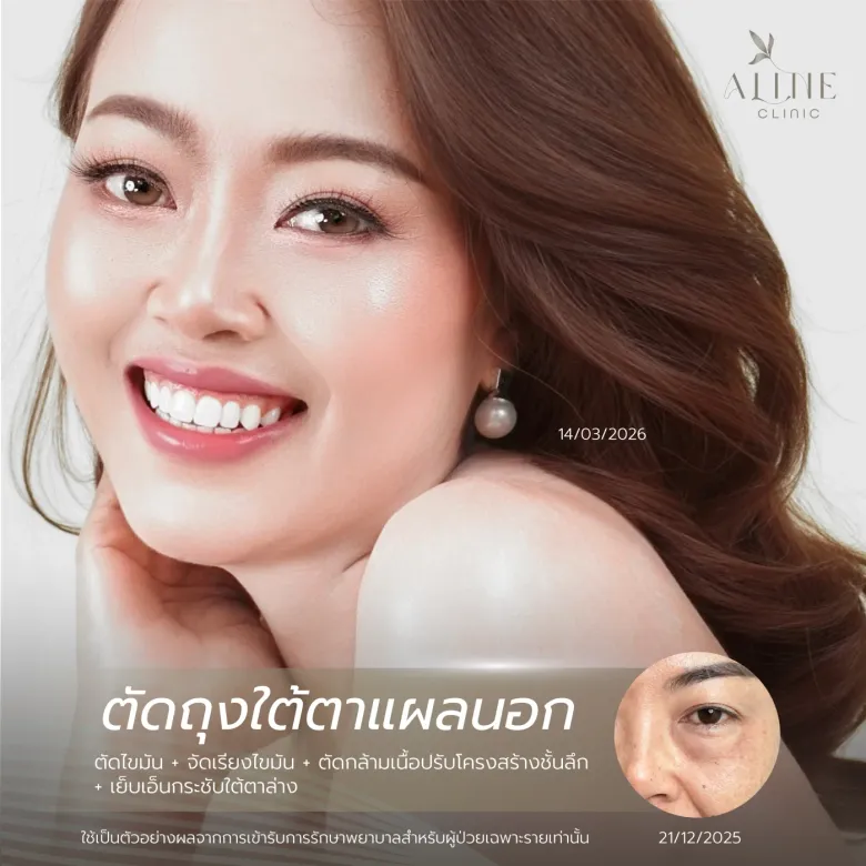 ผ่าตัดถุงใต้ตา ราคาเท่าไหร่? เช็กโปรโมชันล่าสุด พร้อมเทคนิคจัดเรียงไขมันที่ ALINE Clinic