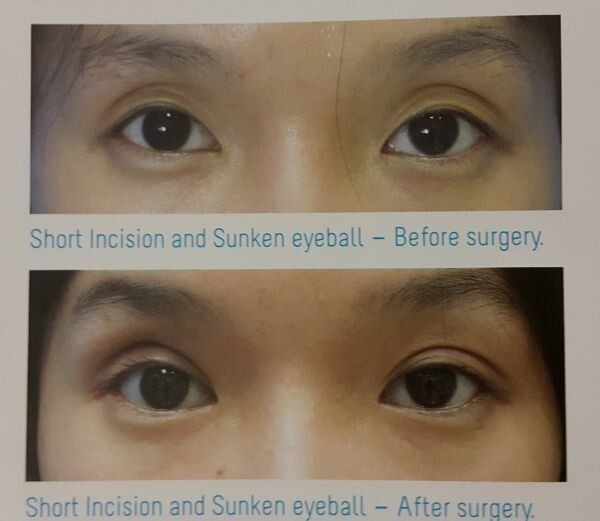 แพทย์แนะเทคนิคทำตาสองชั้น ด้วยวิธีเจาะรู-ดูดไขมัน ทางเลือกของสาวหมวย ที่อยากมีตาสวย กลมโต!!!
