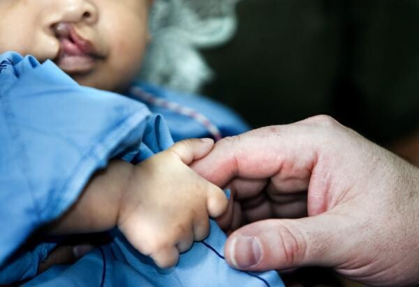 ผ่าตัดฟรี สำหรับเด็กปากแหว่งเพดานโหว่ และมือติด เท้าติด เพื่อเฉลิมพระเกียรติฯ