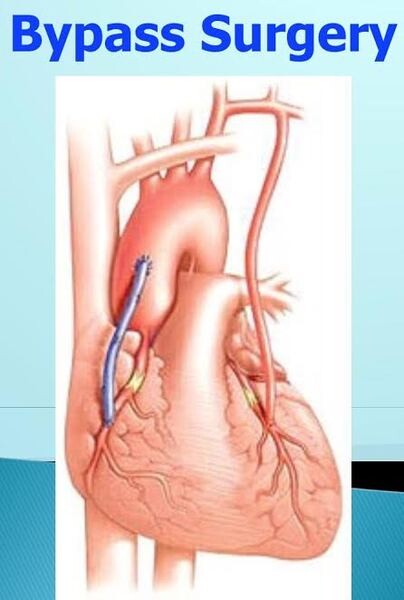 คนอ้วนเสี่ยงเป็นโรคหลอดเลือดหัวใจ ตีบหรือตัน (coronary artery disease)