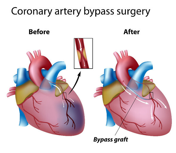 ผ่าตัดบายพาสหลอดเลือดหัวใจแบบไม่ต้องหยุดหัวใจ (OFF-PUMP CABG) ลดความเสี่ยง ทางเลือกการรักษาผู้สูงอายุ และมีโรคแทรกซ้อน
