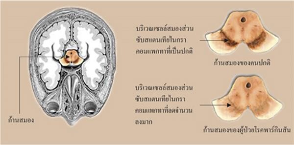 ความรู้โรคพาร์กินสันเพื่อประชาชน รศ.พญ.ศิวาพร จันทร์กระจ่าง ราชวิทยาลัยอายุรแพทย์แห่งประเทศไทย