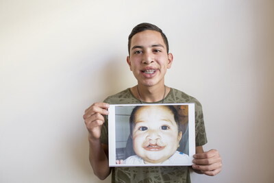 สมาพันธ์ทันตแพทย์โลก จับมือ Smile Train เปิดตัวโครงการยกระดับการดูแลสุขภาพช่องปากของเด็กที่มีภาวะปากแหว่งเพดานโหว่
