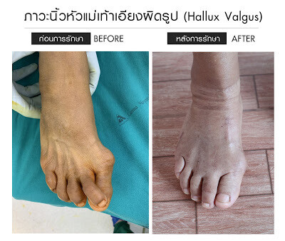 "นิ้วเท้าเอียงผิดรูป" ปัญหาที่สร้างความเจ็บปวดให้มาเนิ่นนาน รพ.ลานนา จัดแพทย์เฉพาะทางด้านข้อเท้า พร้อมรักษาได้ถึงขั้น "ผ่าตัด"