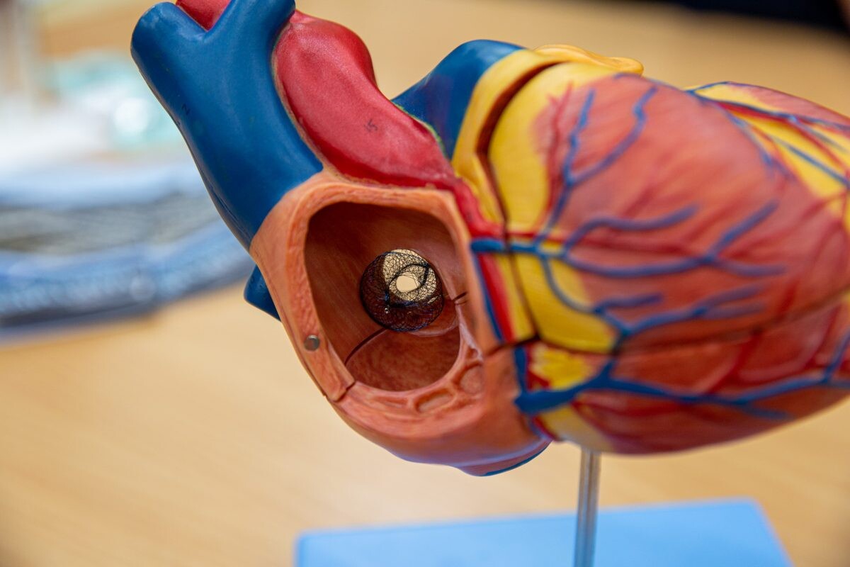 'อุปกรณ์ถ่างขยายผนังหัวใจห้องบน' นวัตกรรมใหม่ทางการแพทย์ สู่การเปลี่ยนแปลงครั้งใหญ่ของการรักษาโรคหัวใจวายเฉียบพลัน ฝีมือนักวิจัยไทย